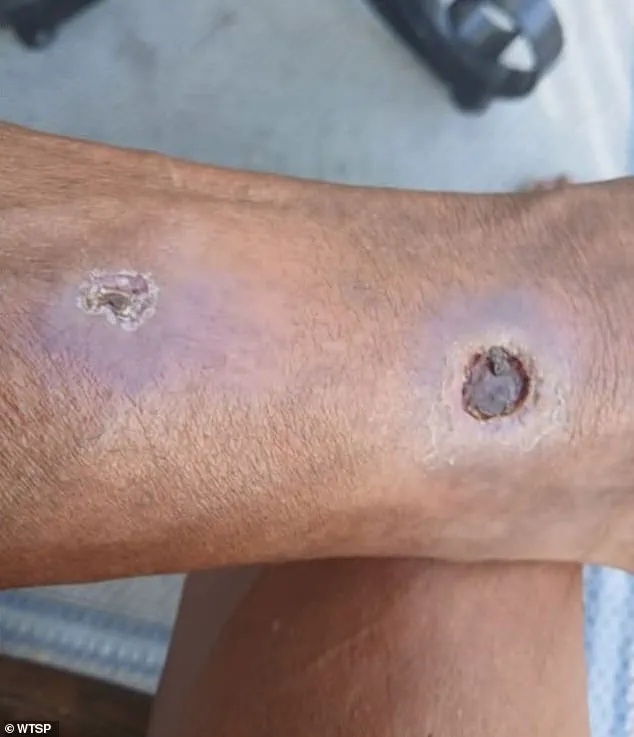 Florida Woman Sues Apartment Complex Alleging Negligence in Spider Infestation That Resulted in Injuries