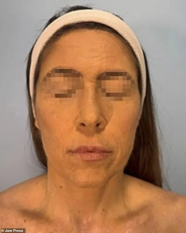 Brazilian Woman Suffers Severe Burns from Rare Drug Reaction