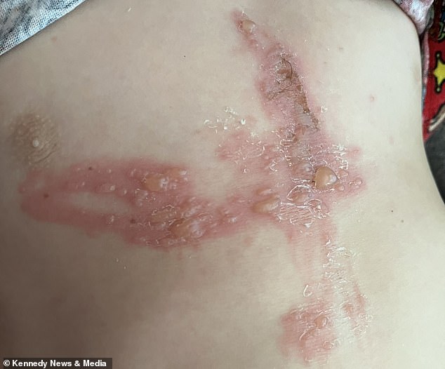 Giant hogweed toy axe leaves Kent boy with severe burns.