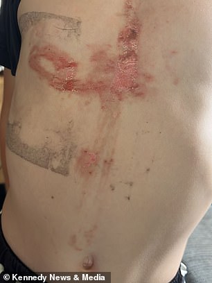 Giant hogweed toy axe leaves Kent boy with severe burns.